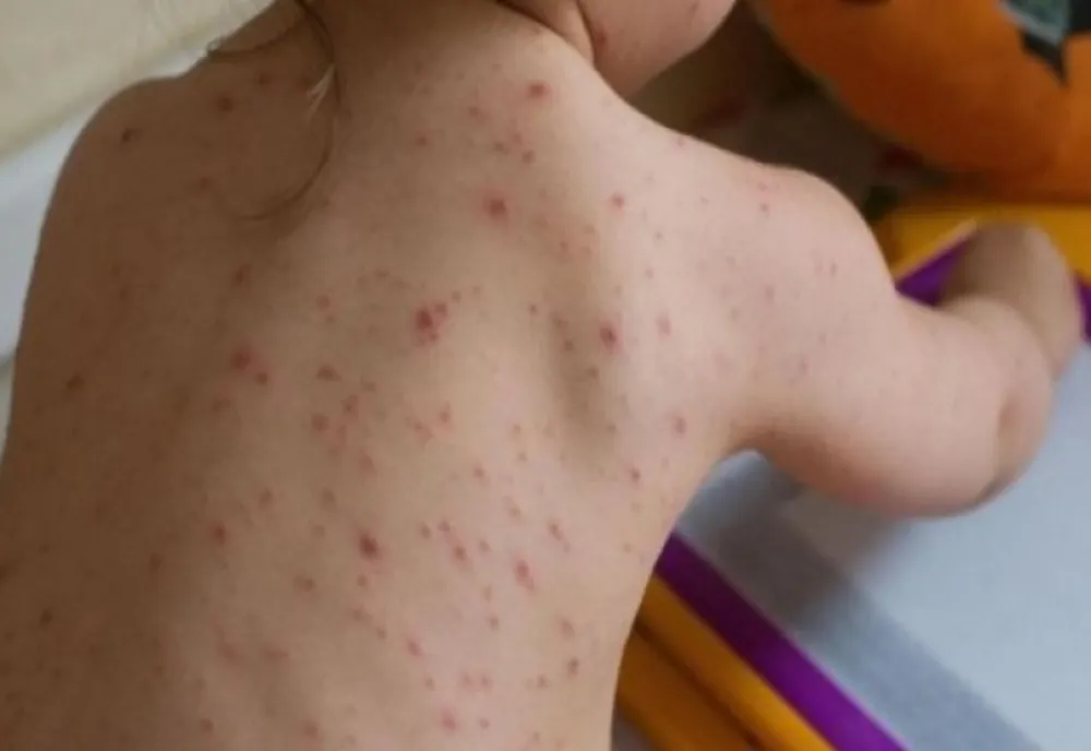 INSP: 64 DE CAZURI DE RUJEOLĂ, ÎNREGISTRATE ÎN LUNA OCTOMBRIE
